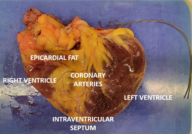 human heart with labels showing epicardial fat, right ventricle, coronary arteries, intraventricular septum, and left ventricle