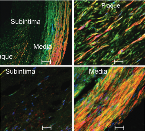 Immunofluorescence of MIRO1 in the left anterior descending artery of a healthy subject and that of a patient with coronary artery disease.